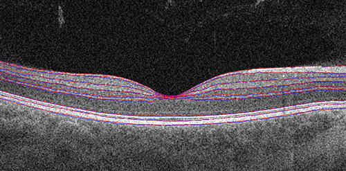 Eye OCT - fundus layers marked by our AI agent vs human